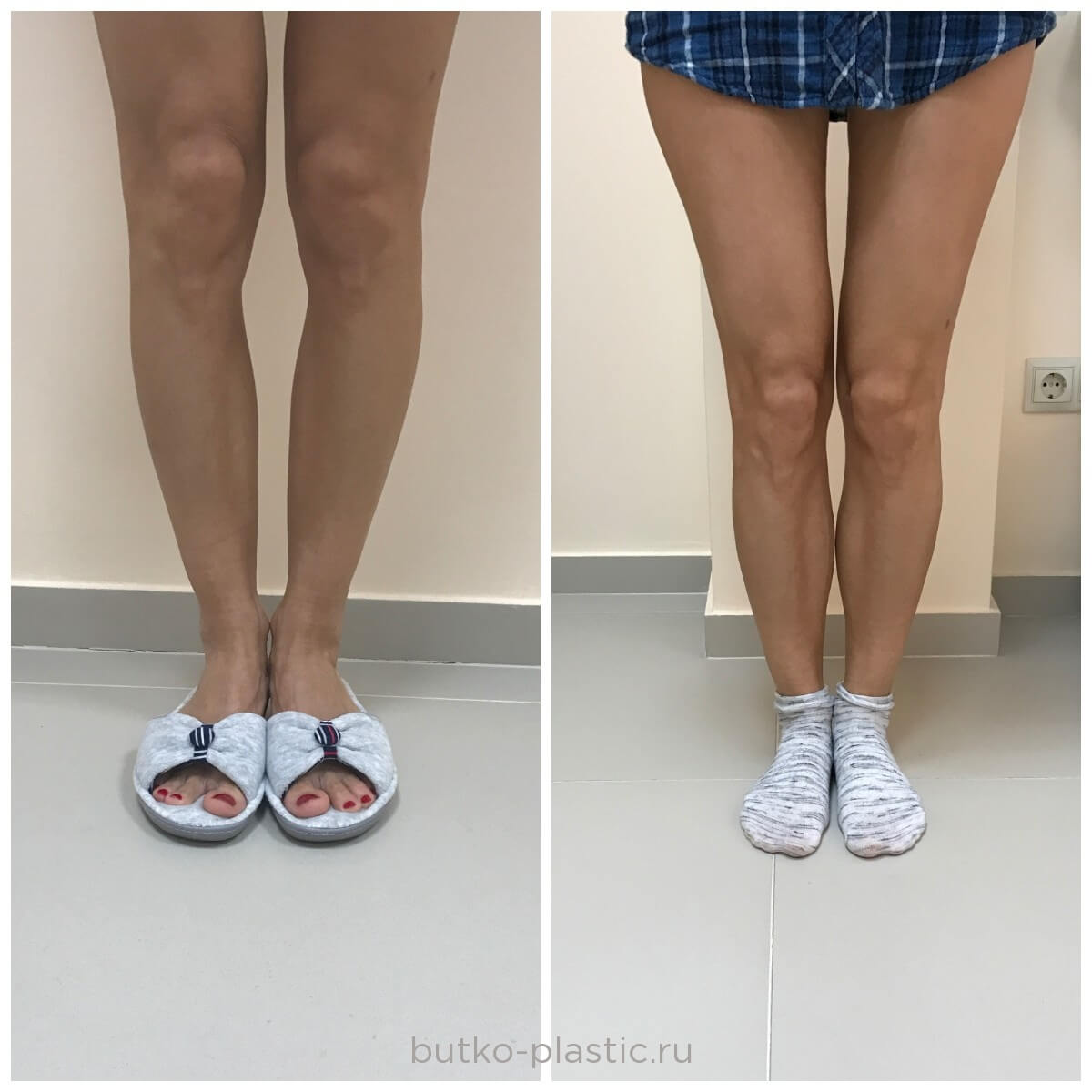 Круропластика ног. Круропластика до и после.