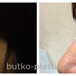 блефаропластика butko plastic: до и после